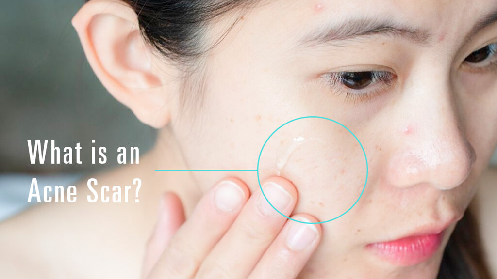 Acne Scars can lead to severe inflammation