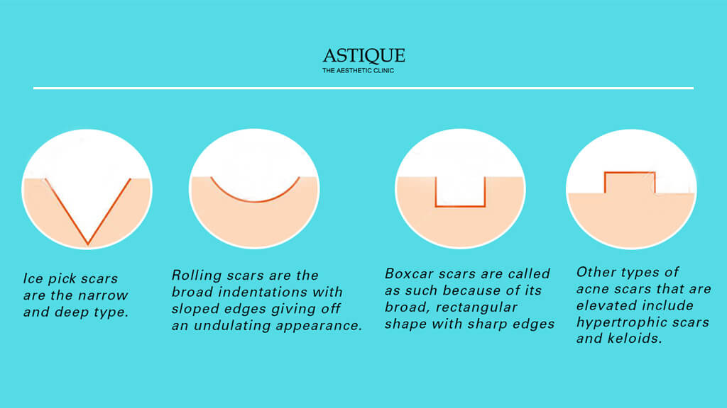 Different types of Acne Scars