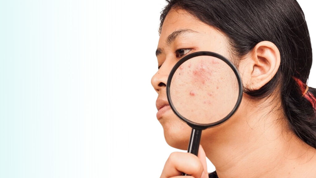 Acne Laser Treatment results vary from skin to skin