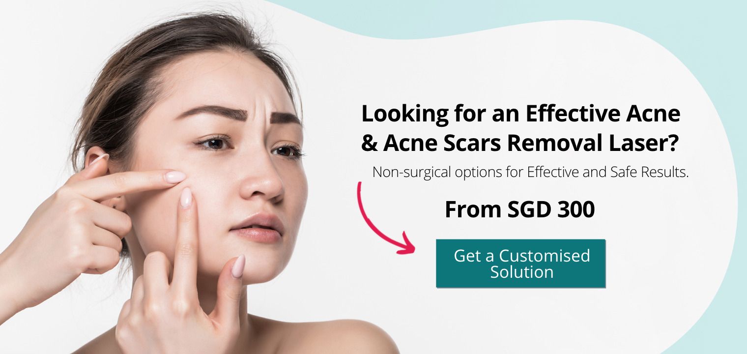 Fotona a Effective Acne & Acne Scar Removal Laser Treatment in Singapore