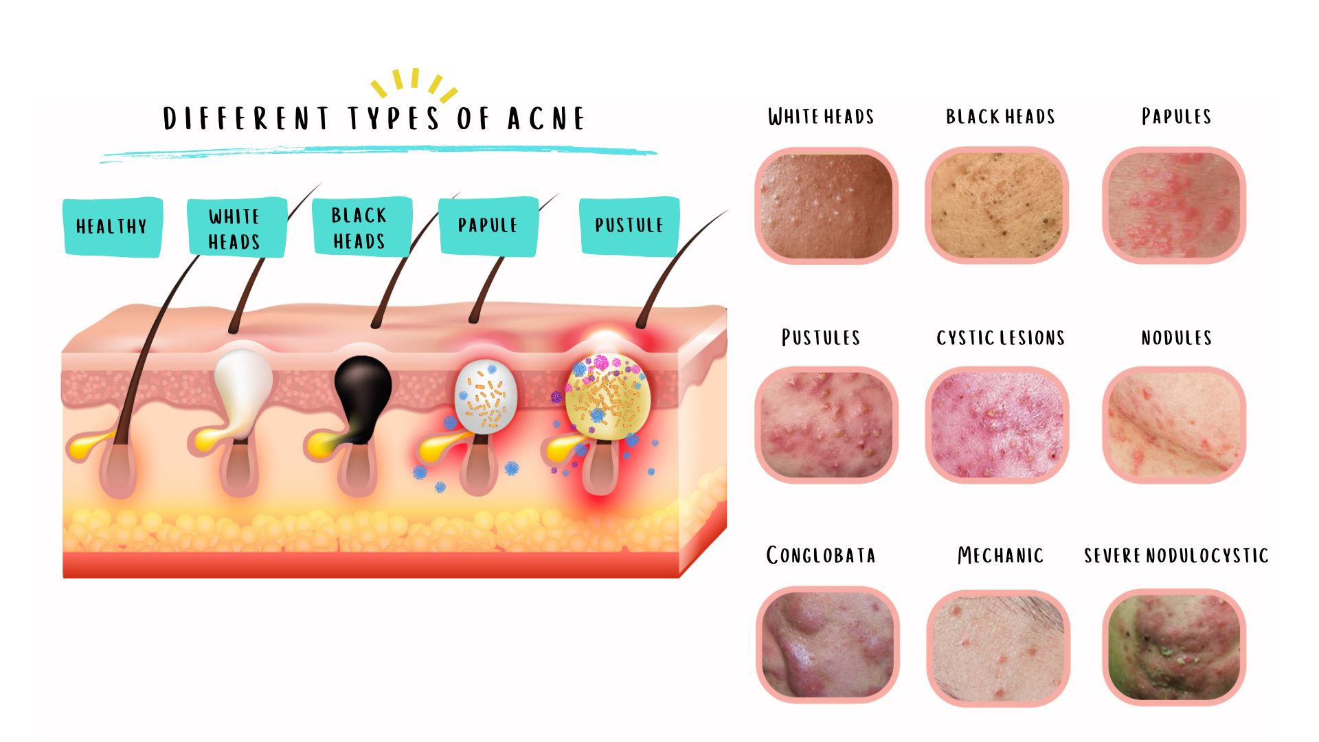 The Different Type of Acne Spectra XT laser can help to reduce and prevent.