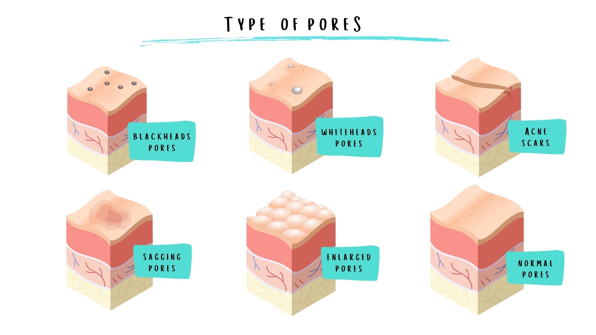 The Different Type of Pores.