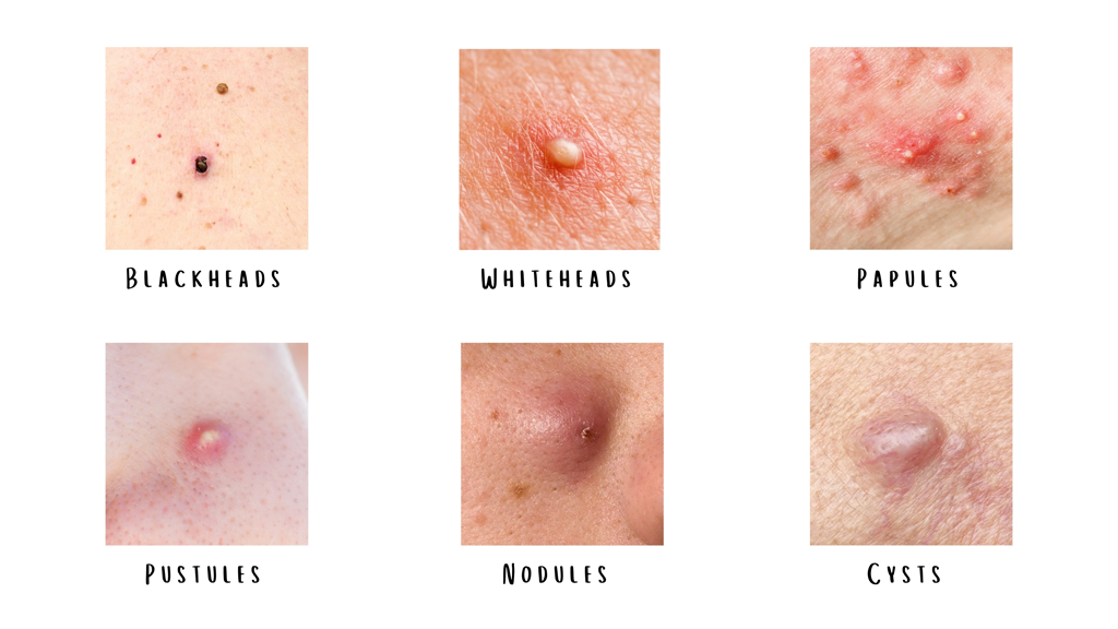 types of acne