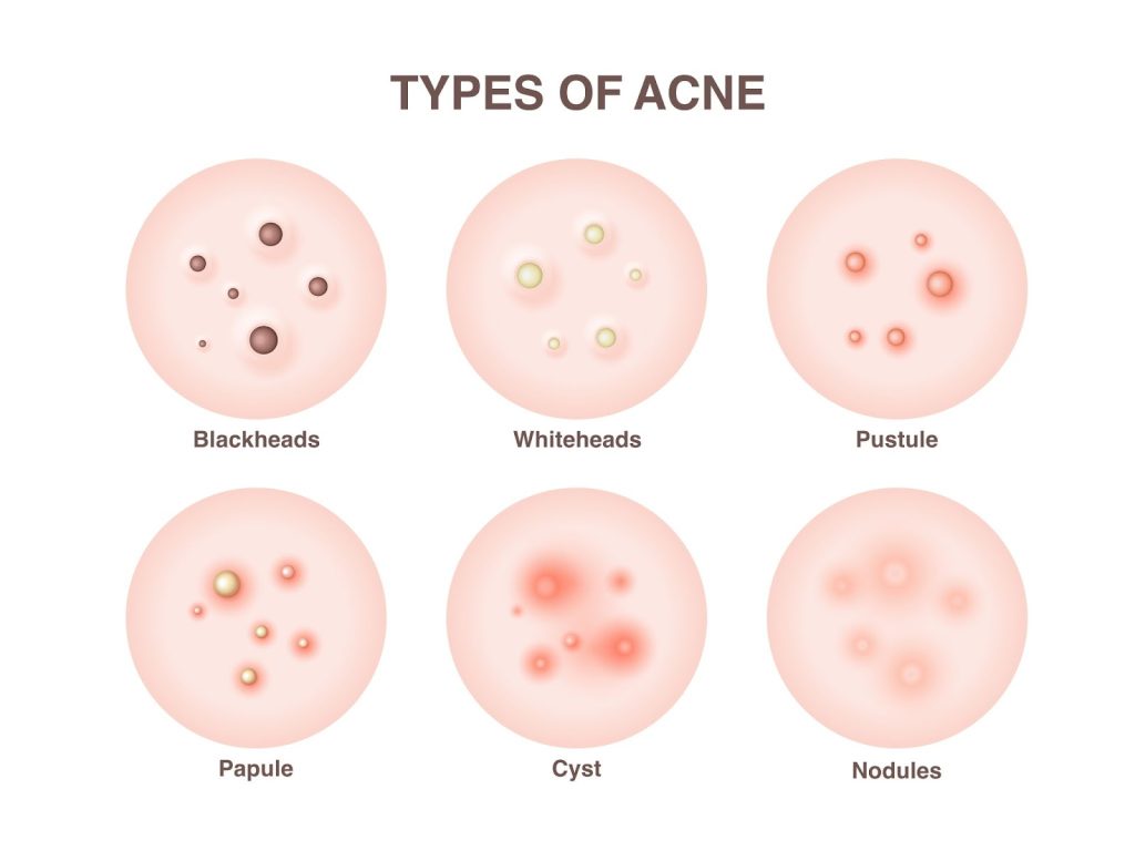 types of acne