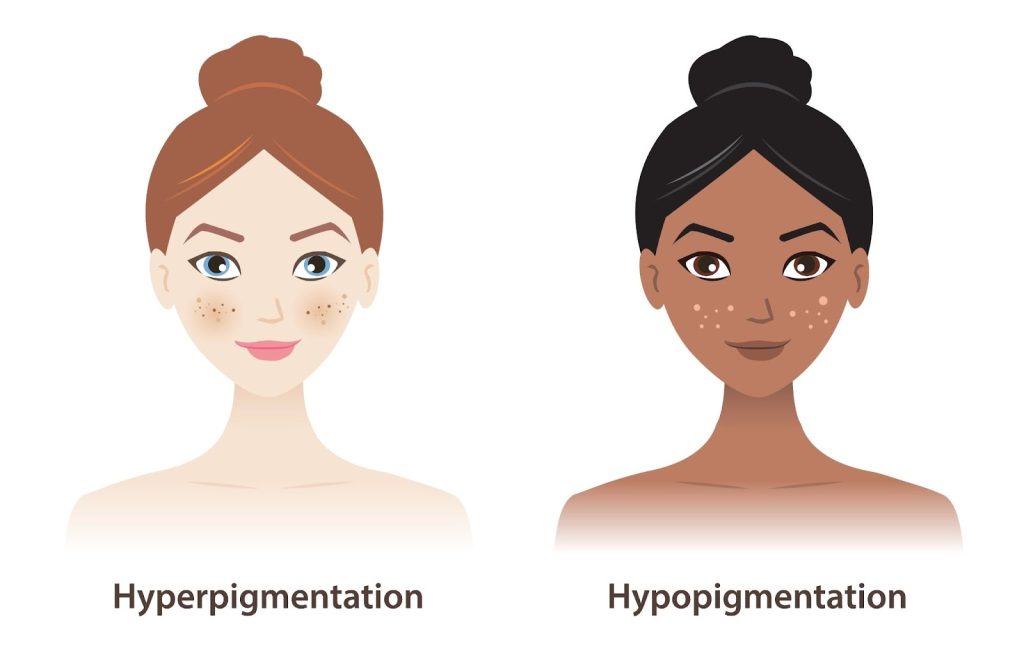 hyperpigmentation symptoms