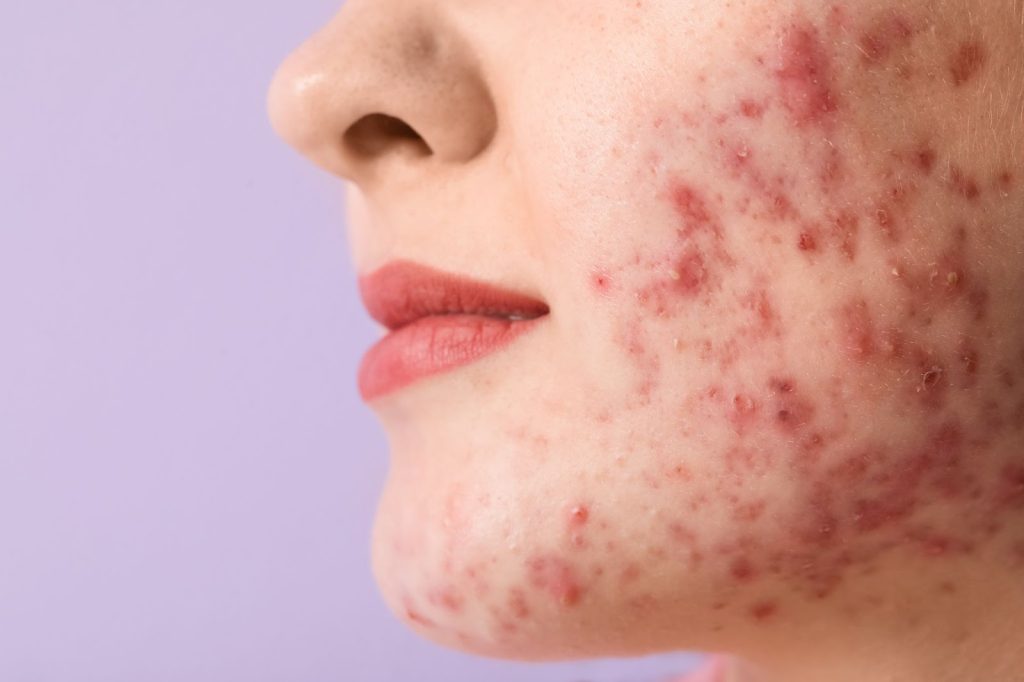 genetics and acne