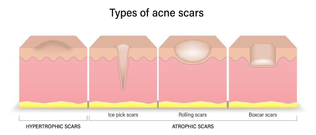 acne scar types