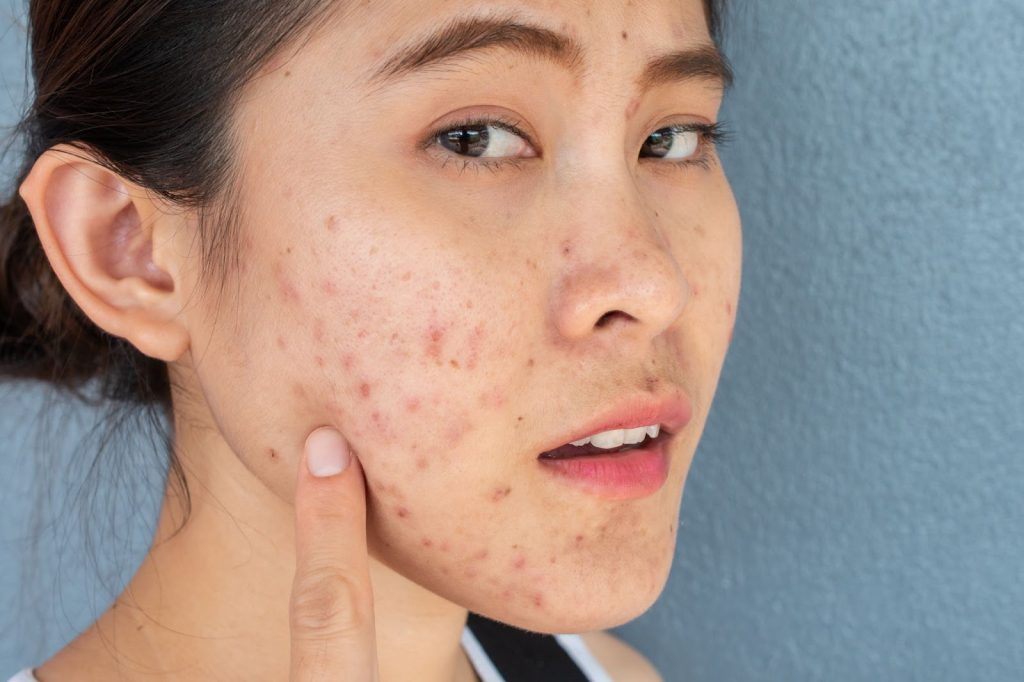 acne scars singapore