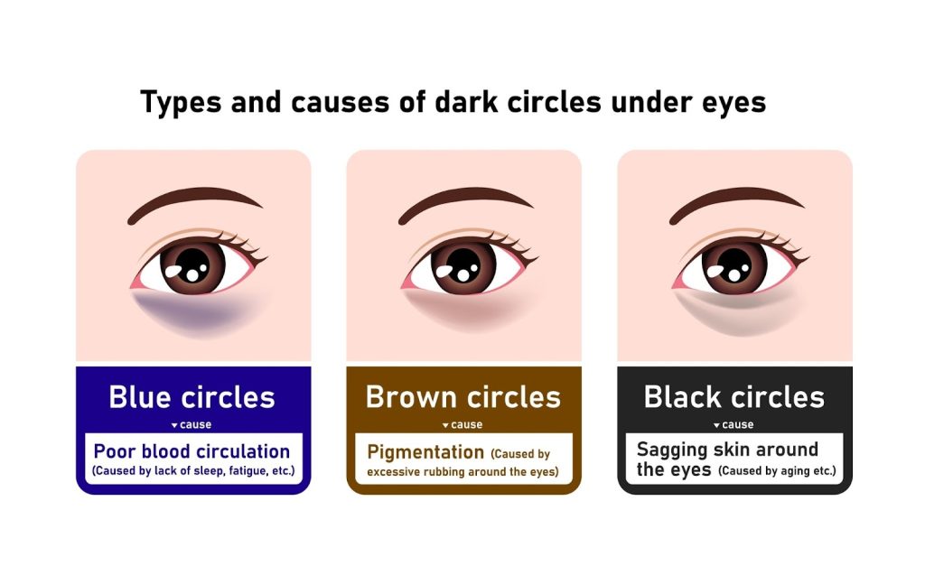 Dark eye circles