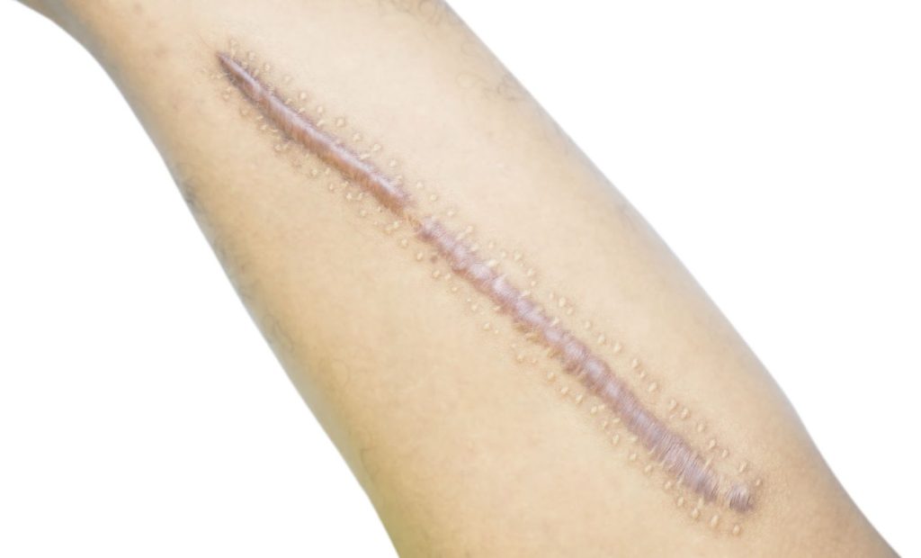 Hypertrophic scars risk