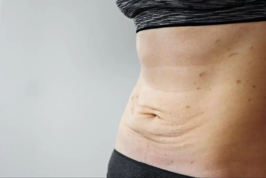 Woman's bare abdomen showing loose crepey skin with stretch marks and sagging skin caused by weight loss or pregnancy