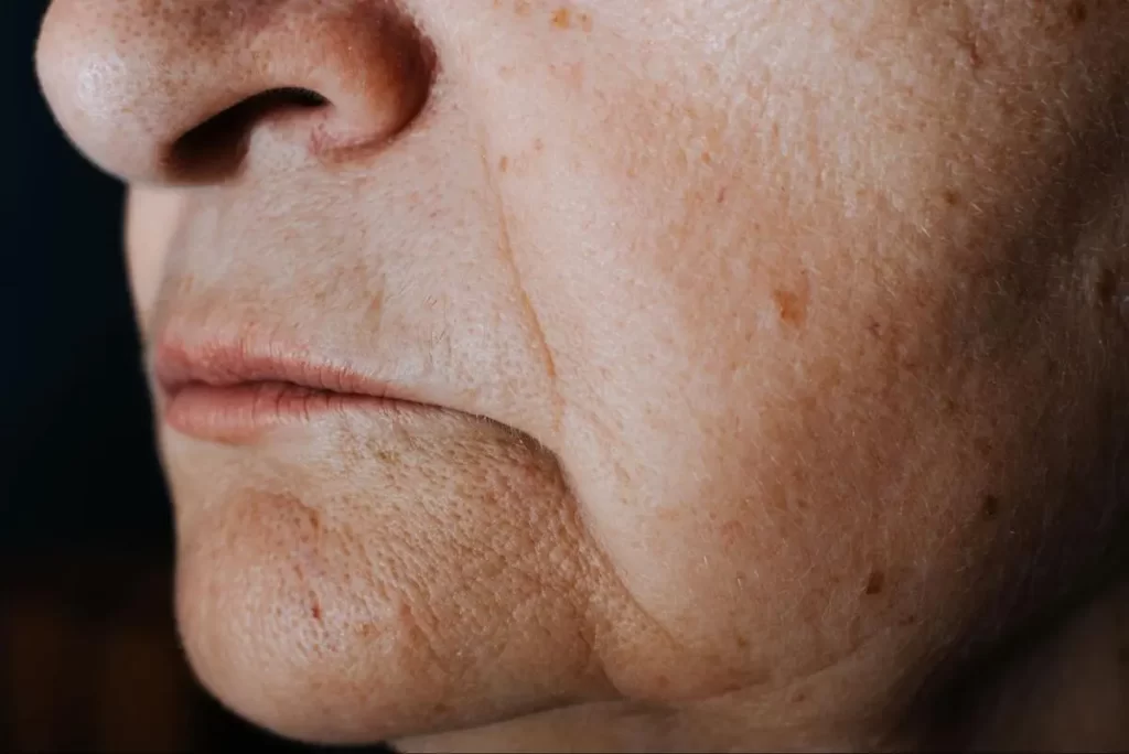 Side profile close-up of a mature person showing wrinkled and loose sagging skin around the nose mouth and jaw area due to ageing