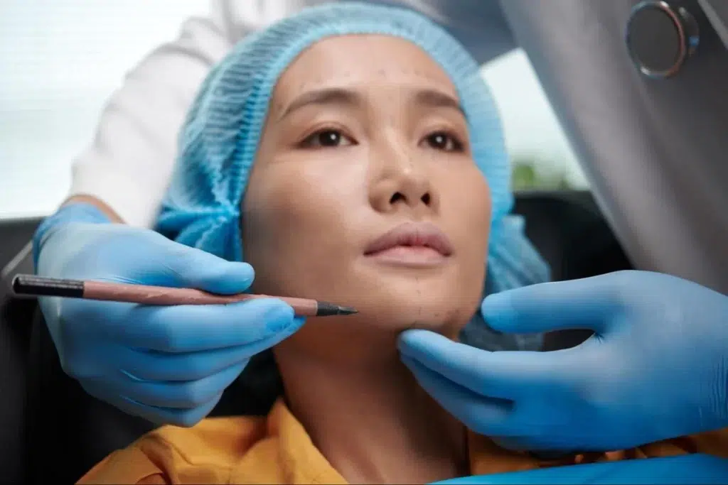 Aesthetic Consultation Before Ultherapy or Thermage Treatment Aesthetic practitioner marking a patient's face before a non-surgical facelift procedure