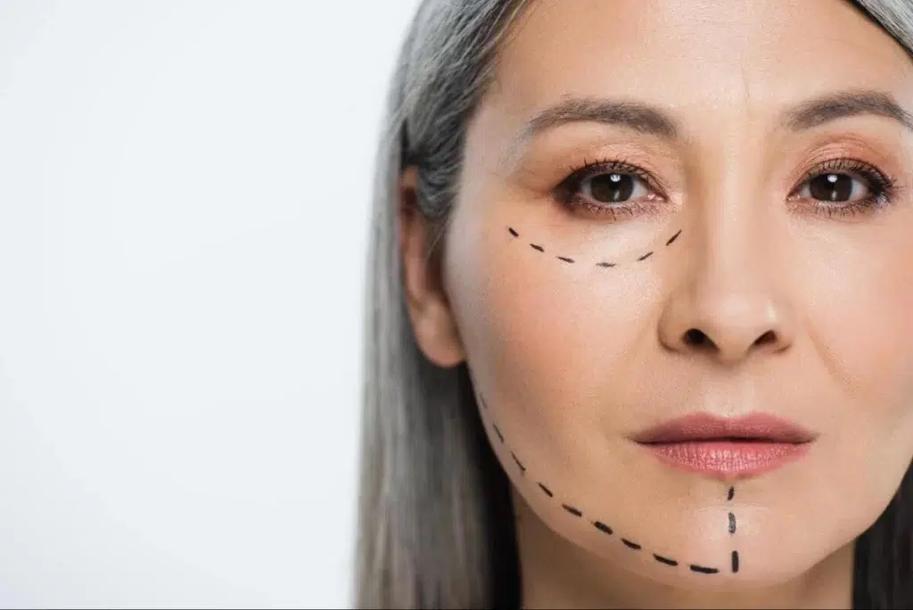 Non-Surgical Skin Tightening Treatment Assessment Middle-aged woman with facial surgical marker lines indicating non-surgical skin tightening treatment zones