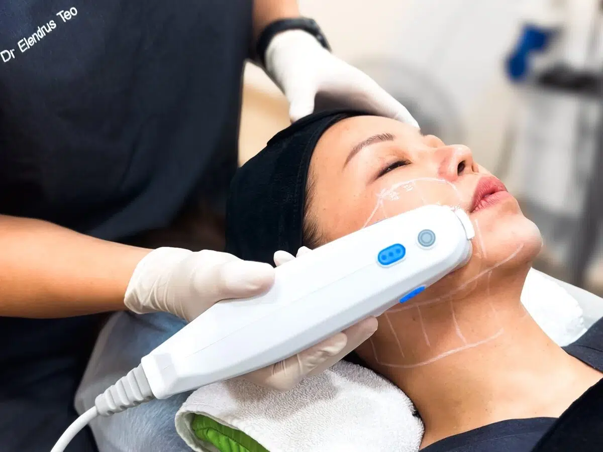 Ultherapy PRIME handpiece on the jawline Ultherapy PRIME handpiece placed along a patient's jawline, with treatment lines marked on the face and neck